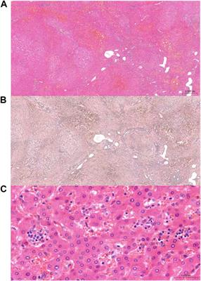 Evidence for Alloimmune Sinusoidal Injury in De Novo Nodular Regenerative Hyperplasia After Liver Transplantation